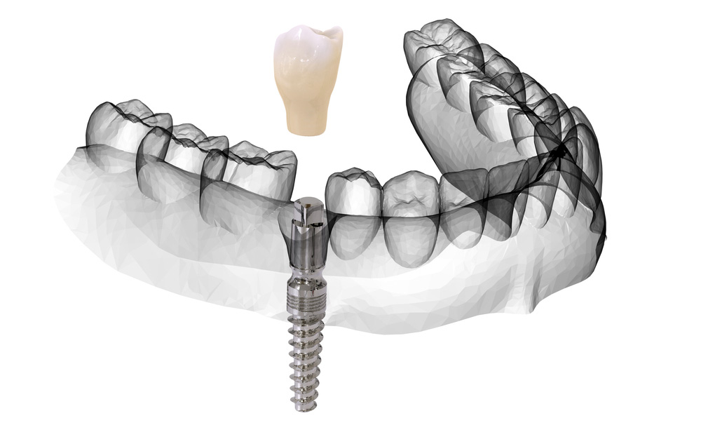Corona-singola-su-impianto-dentale diga di gomma