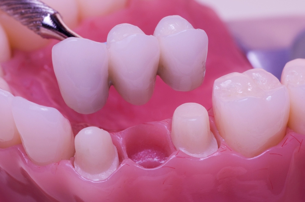 Ponte-dentale-su-denti-naturali diga di gomma