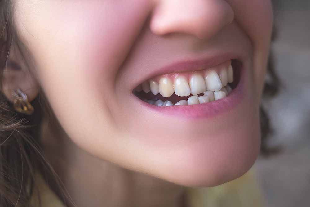 Photo,Of,Crooked,Woman,Teeth